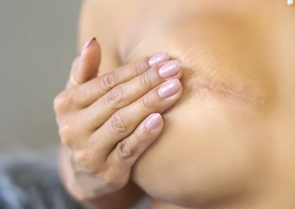 Correlation Breast Reduction and Cancer